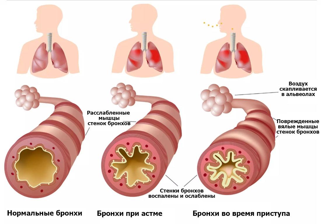Симптомы атопической бронхиальной астмы