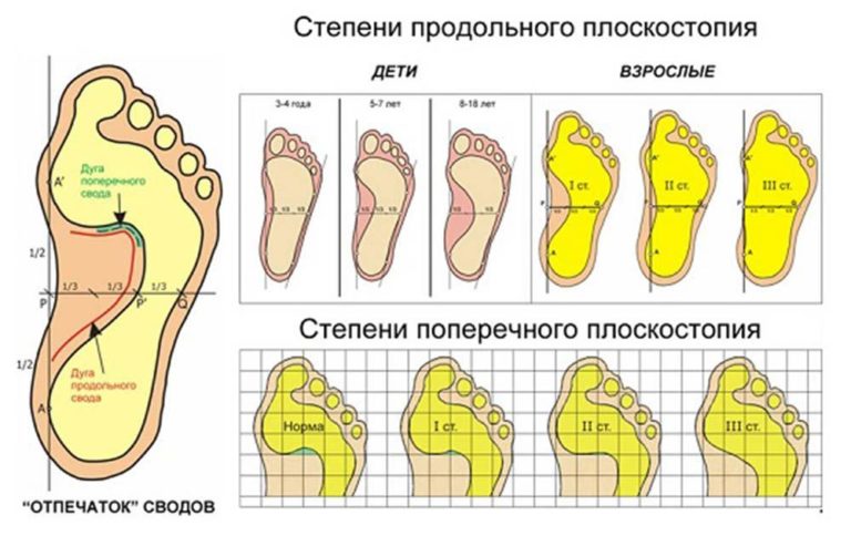 Степени плоскостопия картинки