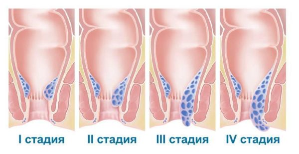 Геморрой и армия