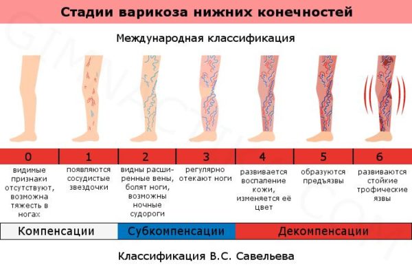 Берут в армию с варикозом