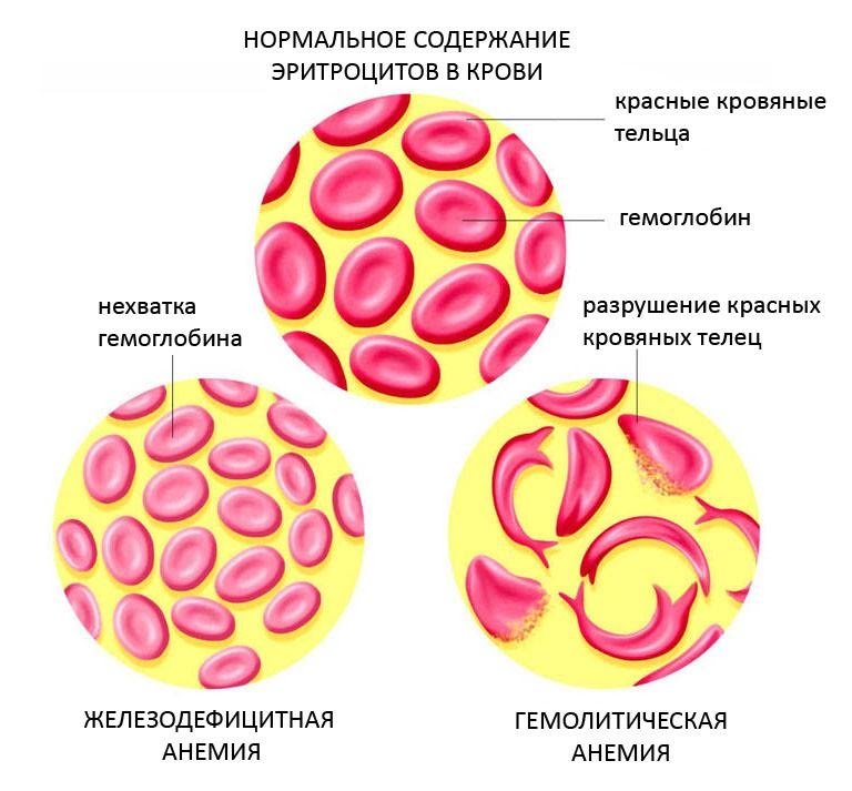 Анемия и эритроциты в крови. Железодефицитная анемия эритроциты форма. Эритроциты при жда. Эритроциты при анемии. Железодефицитная анемия Эрит.