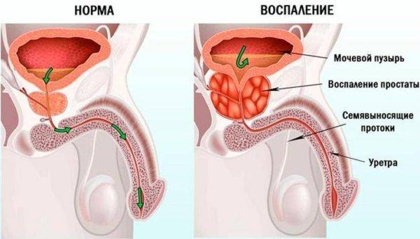 Межпозвоночная грыжа и служба в армии | Категория годности с грыжей позвоночника