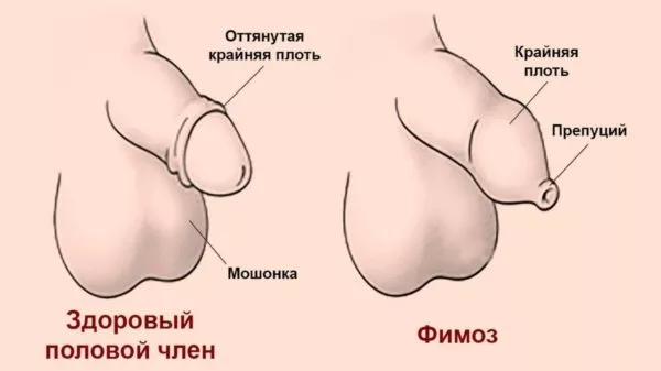 Берут ли в армию с фимозом