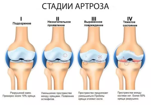 Берут ли с артрозом в армию