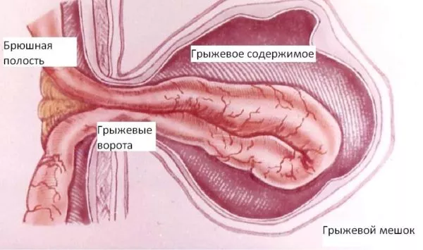 Армия и грыжа