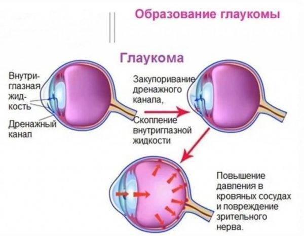 Первичная глаукома — что это, причины, симптомы и лечение