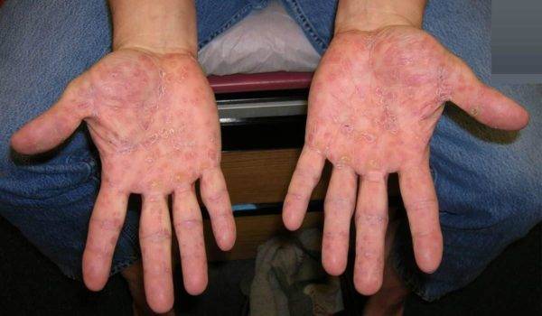 Аллергия на руках у взрослых