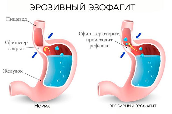 Схема лечения рефлюкс эзофагита самые эффективные