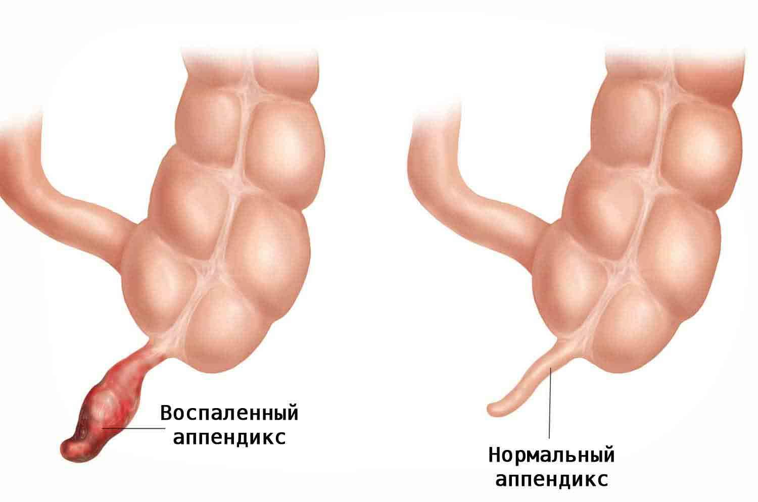 Аппендицит с какой стороны картинка