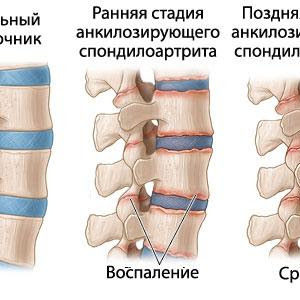 Угол бойлера пяточной кости