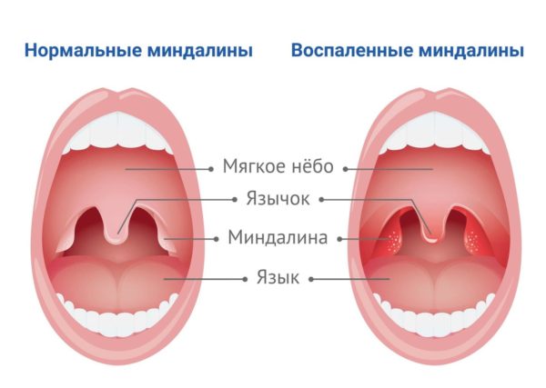 Тонзиллит