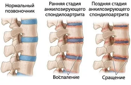 Болезнь бехтерева мобилизация
