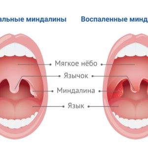 Половые инфекции | Медицинский центр «Академия VIP» в Нижнем Новгороде