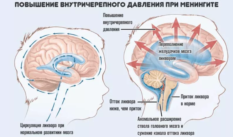 Артериальная гипертензия армия
