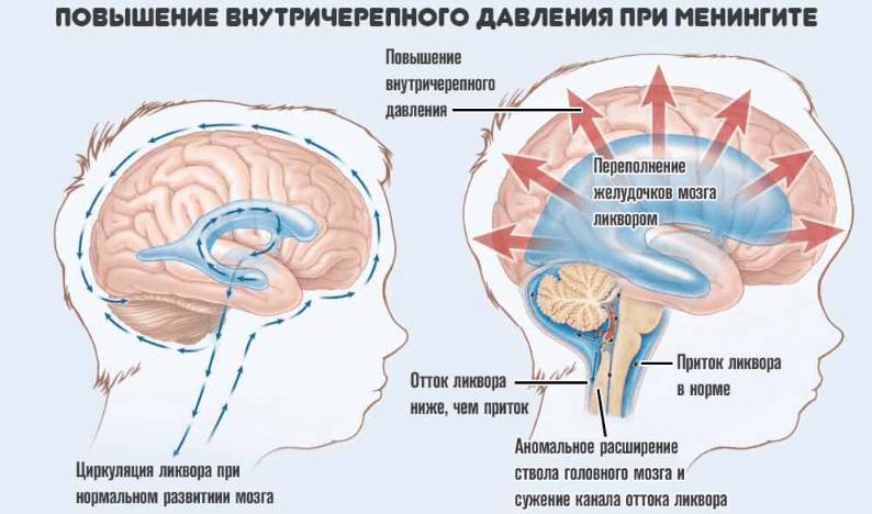 Берут ли в армию с протрузией?